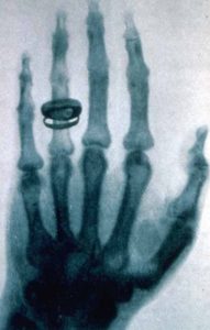 Röntgen kéz